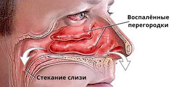 ЕСТЬ 3 СПОСОБА ИЗБАВИТЬСЯ ОТ НАСМОРКА ЗА 30 МИНУТ