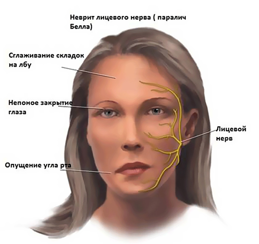 Схема лечения паралича белла